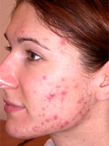 acne rosacea treatment