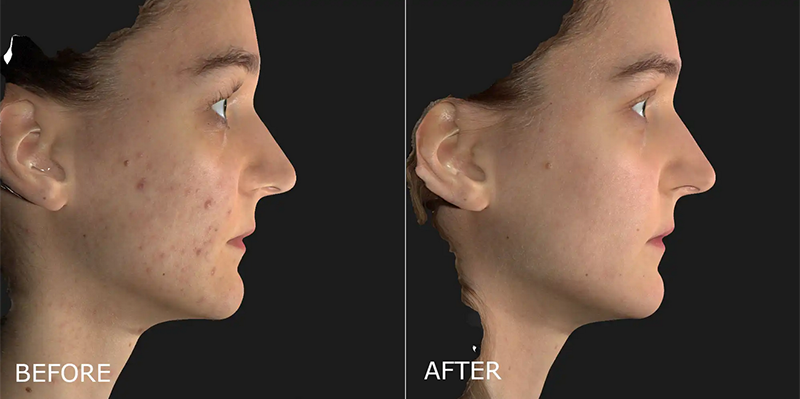 Acne Before and After Photo by Dr. Crippen in Kelowna, BC