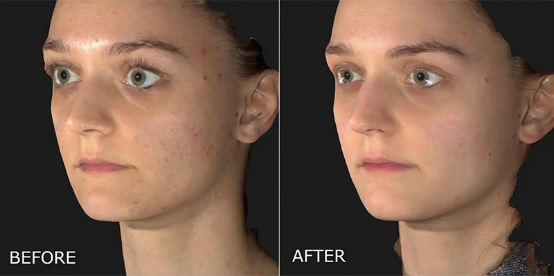 Acne Before and After Photo by Dr. Crippen in Kelowna, BC