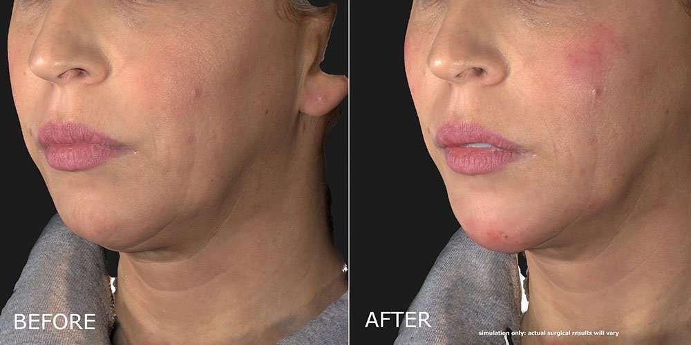 Filler – Chin Before and After Photo by Dr. Crippen in Kelowna, BC