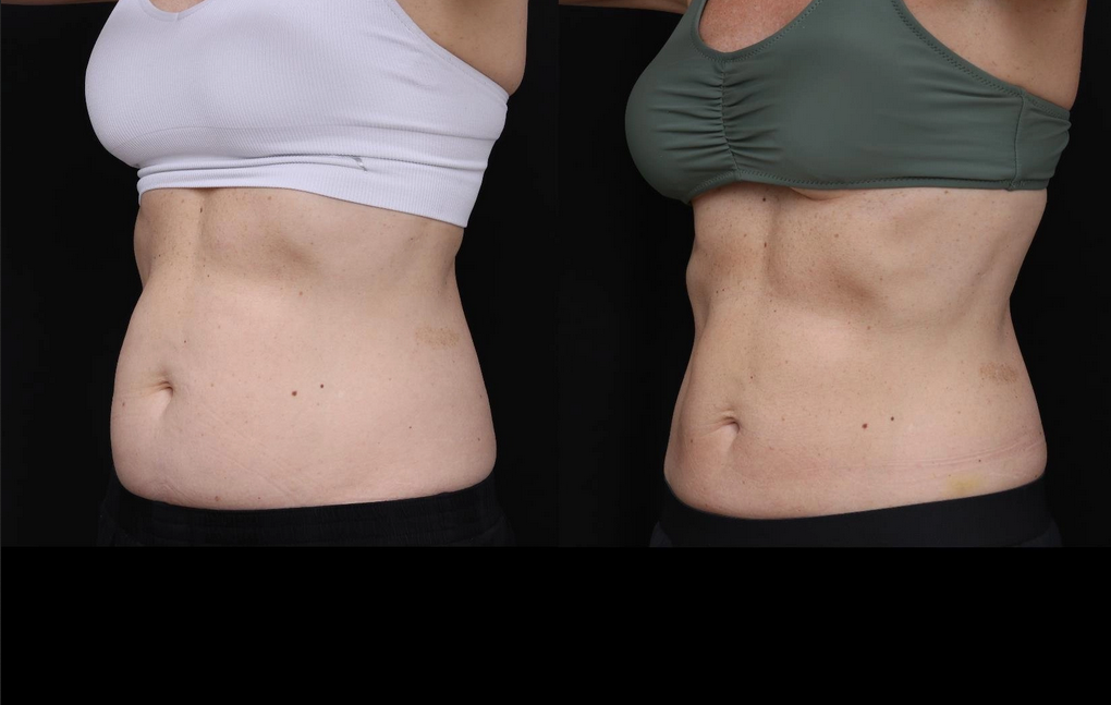 CoolSculpting Before and After Photo by Dr. Crippen in Kelowna, BC