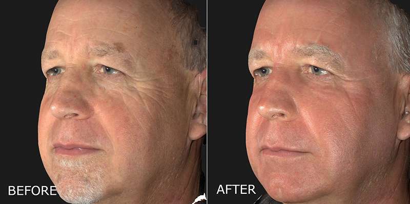 DermaPeel – Laser Skin Resurfacing Before and After Photo by Dr. Crippen in Kelowna, BC