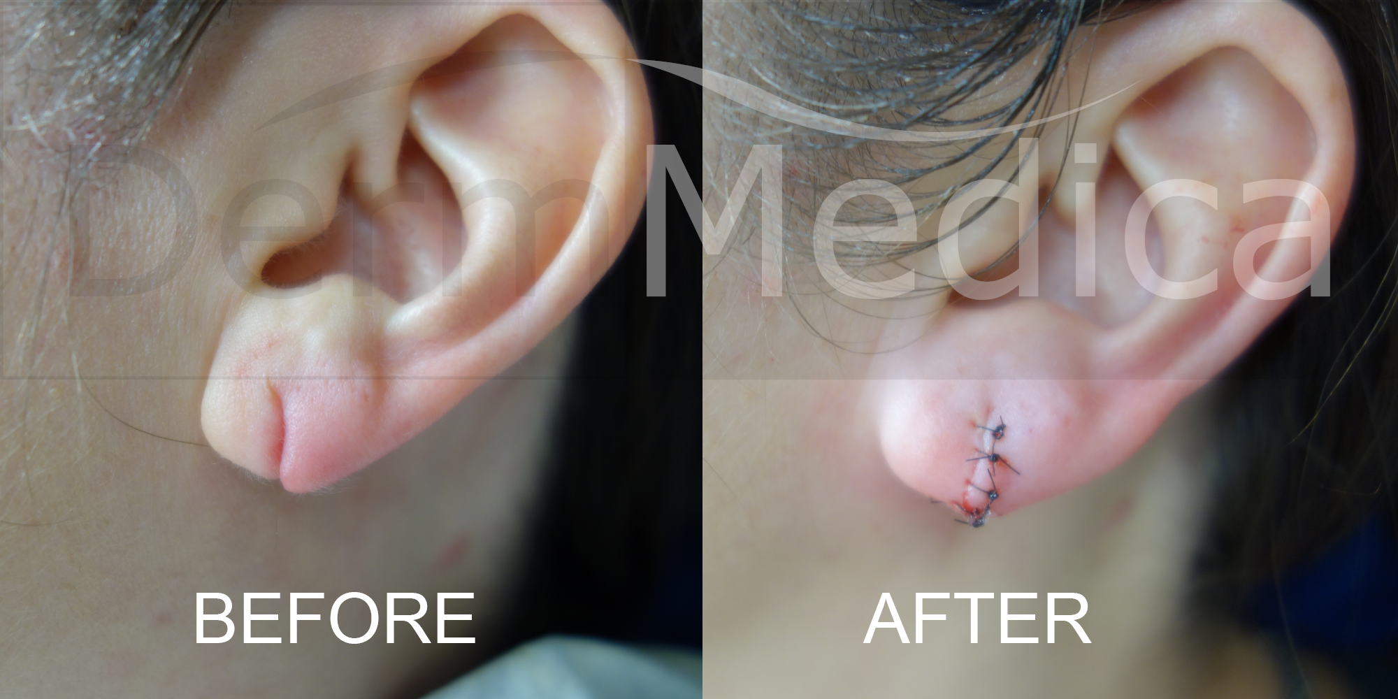 Ear Lobe Repair Before and After Photo by Dr. Crippen in Kelowna, BC