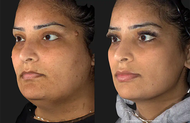Mole Removal Before and After Photo by Dr. Crippen in Kelowna, BC