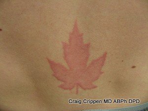 erase tattoo mistakes with laser tattoo removal before