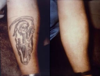 erasing bad ideas with laser tattoo removal
