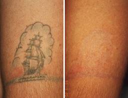 make bad tattoos disappear with lasers
