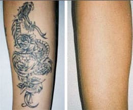 more reasons for kelowna laser tattoo removal