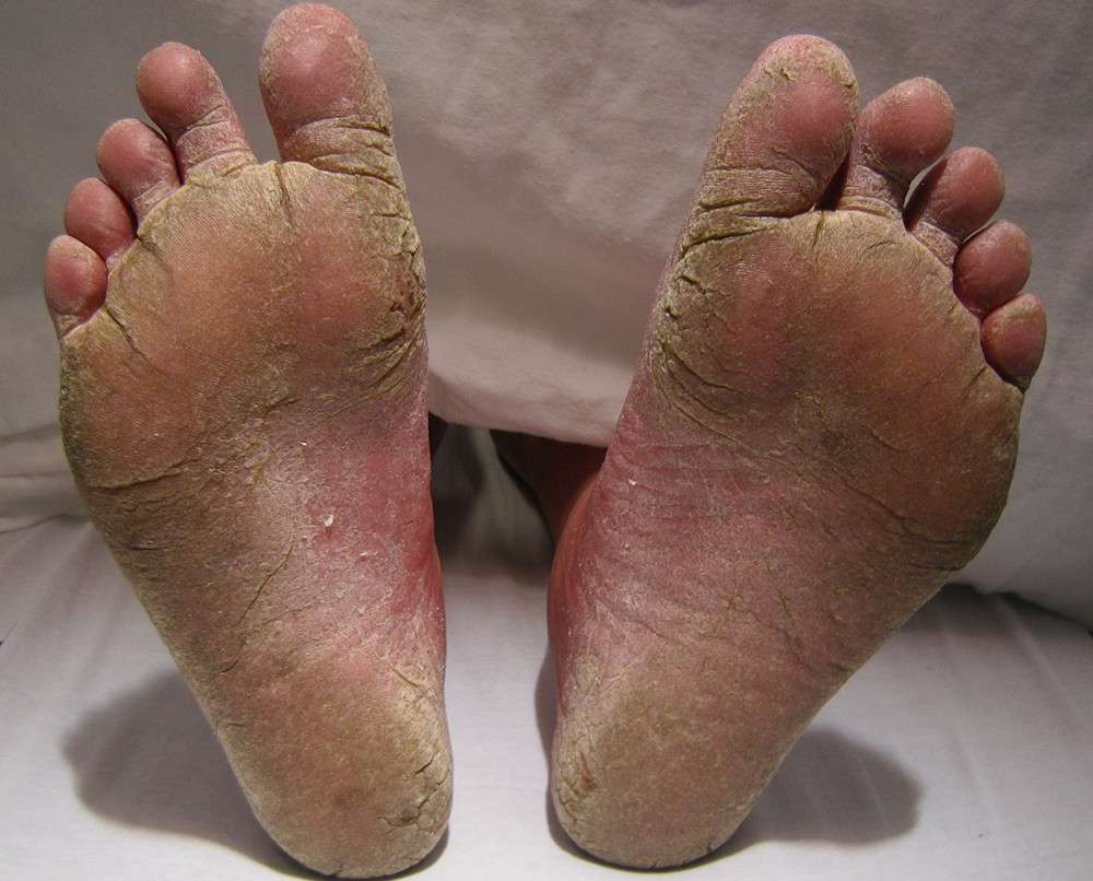 foot-calluses01