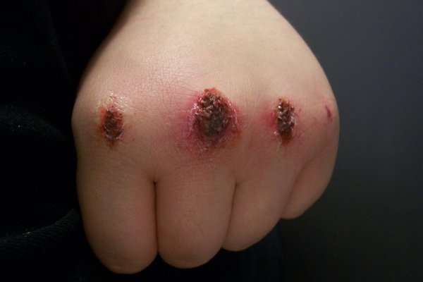 Knuckle Scabs