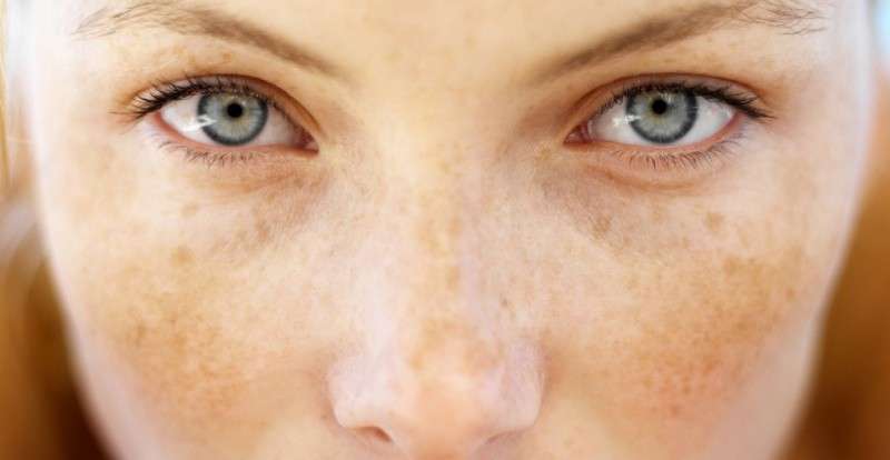 Everything You Need To Know About Freckles