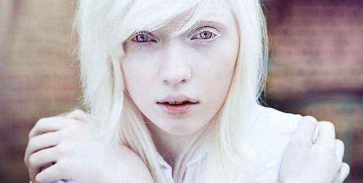 What Is Albinism Dermmedica