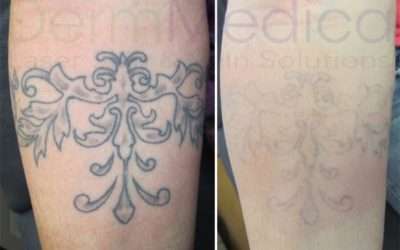 Looking to Cover Up an Old Tattoo with an New One? Laser Tattoo Removal Can Help