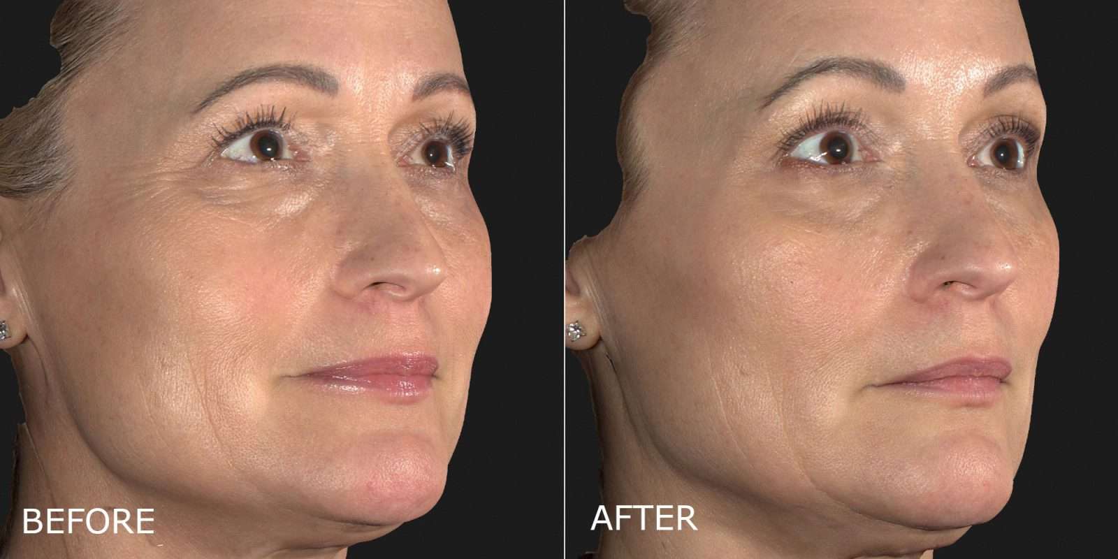 Botox Cosmetic Before and After Photo by Dr. Crippen in Kelowna, BC
