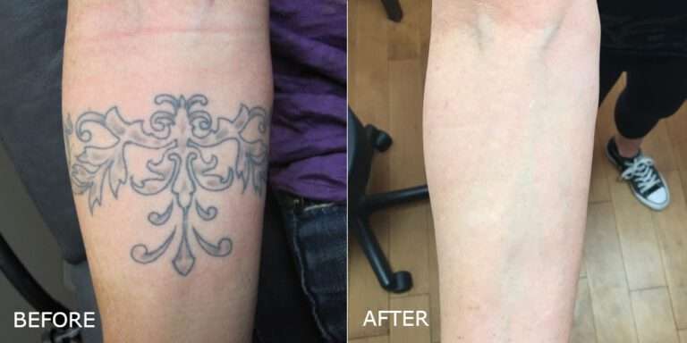 Laser Tattoo Removal Before and After Photo by Dr. Crippen in Kelowna, BC