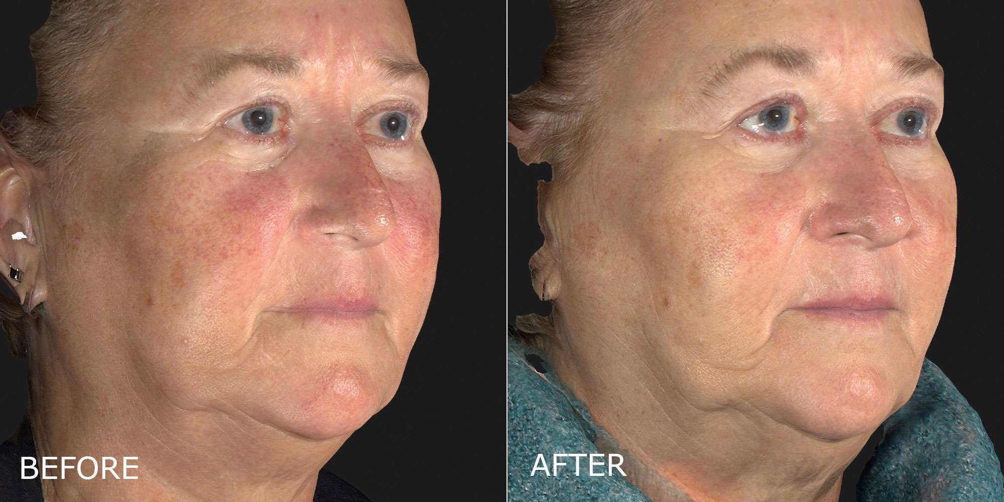 Laser for Redness Before and After Photo by Dr. Crippen in Kelowna, BC
