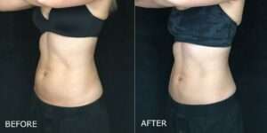 Thumbnail of http://CoolSculpting%20Before%20and%20After%20Photo%20by%20Dr.%20Crippen%20in%20Kelowna,%20BC