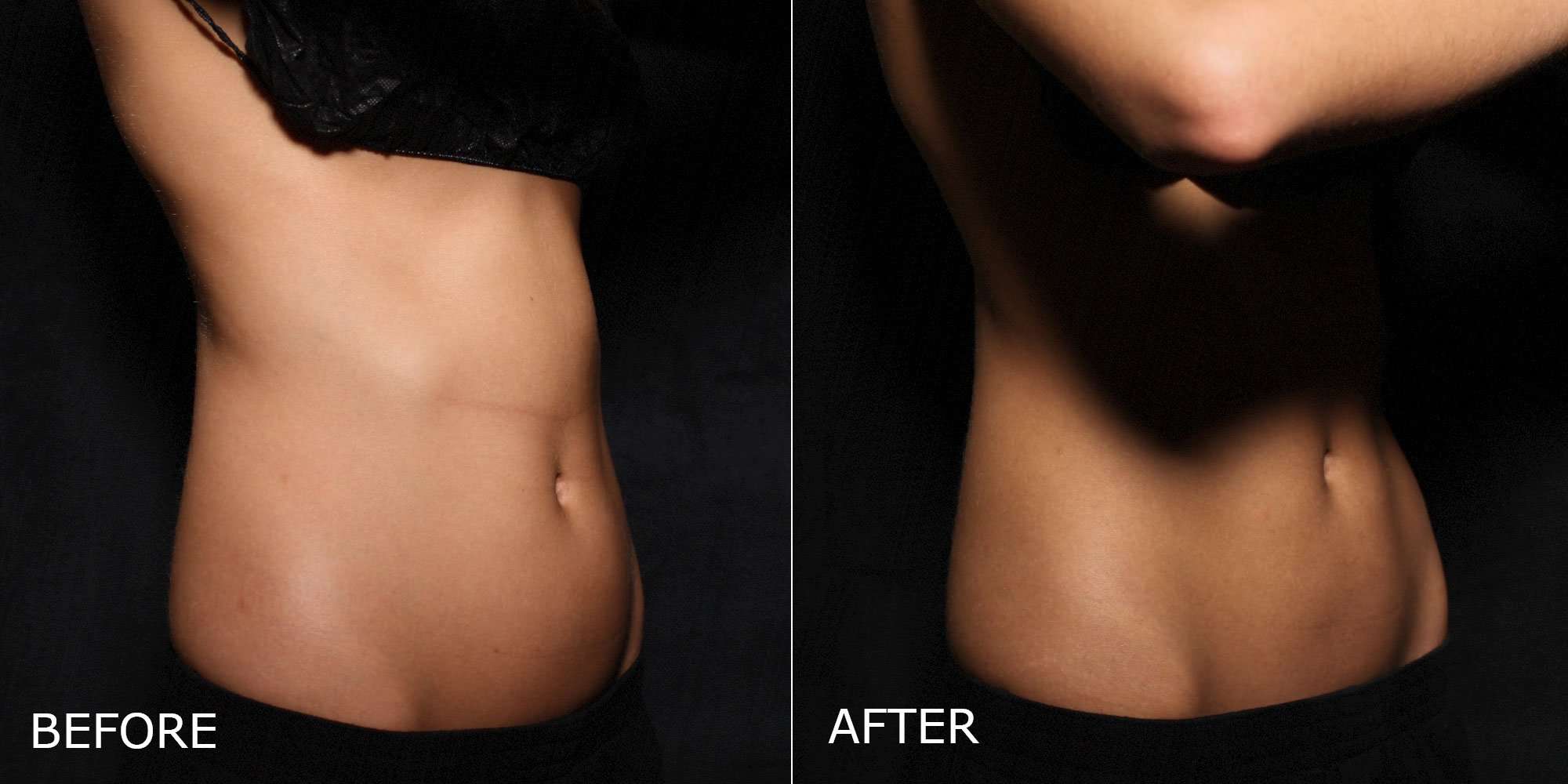 CoolSculpting Before and After Photo by Dr. Crippen in Kelowna, BC