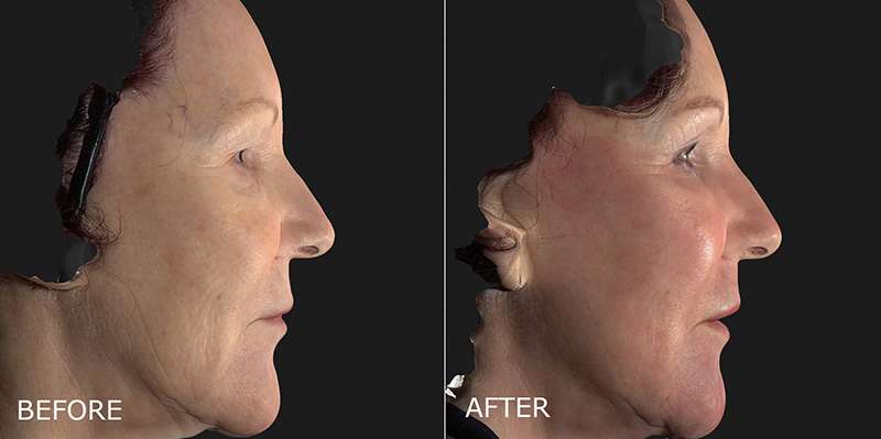 DermaPeel – Laser Skin Resurfacing Before and After Photo by Dr. Crippen in Kelowna, BC
