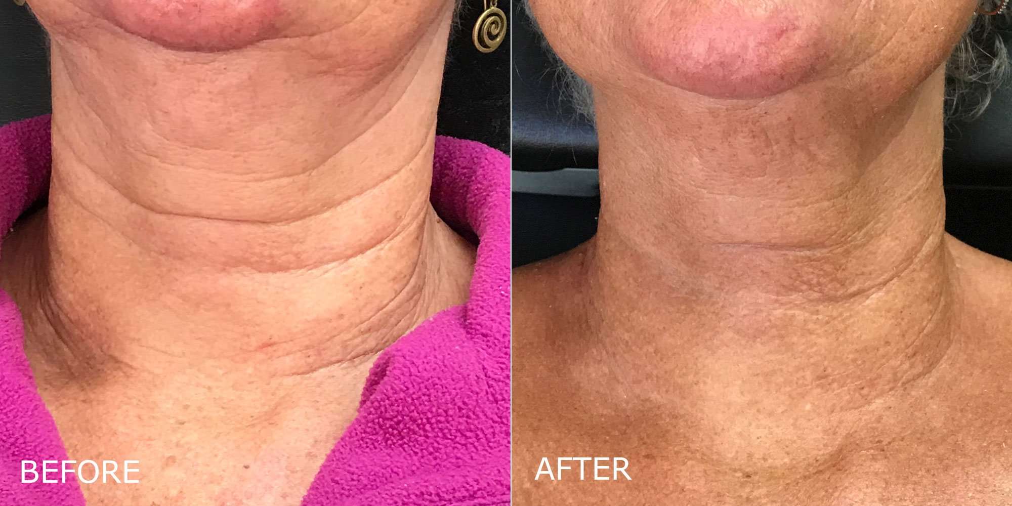 Filler – Neck Lines Before and After Photo by Dr. Crippen in Kelowna, BC