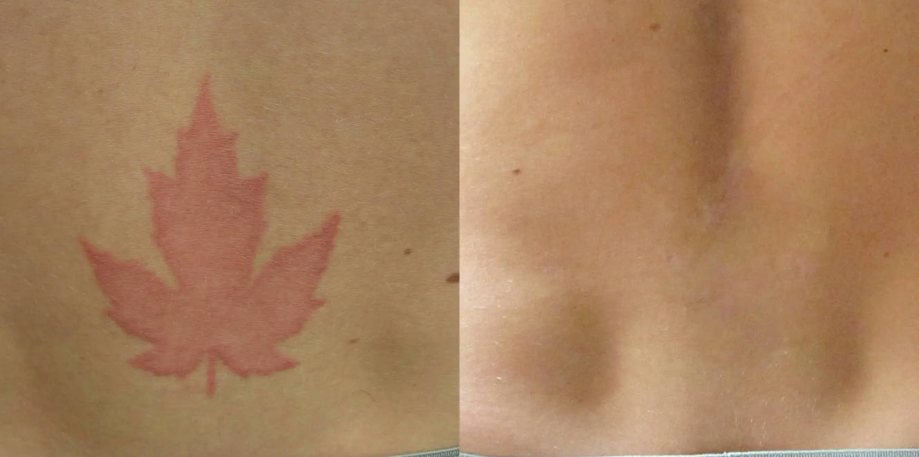 Laser Tattoo Removal Before and After Photo by Dr. Crippen in Kelowna, BC