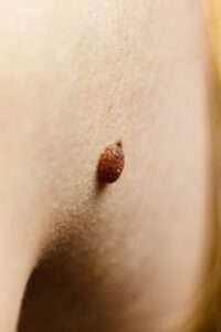 up-close image of mole