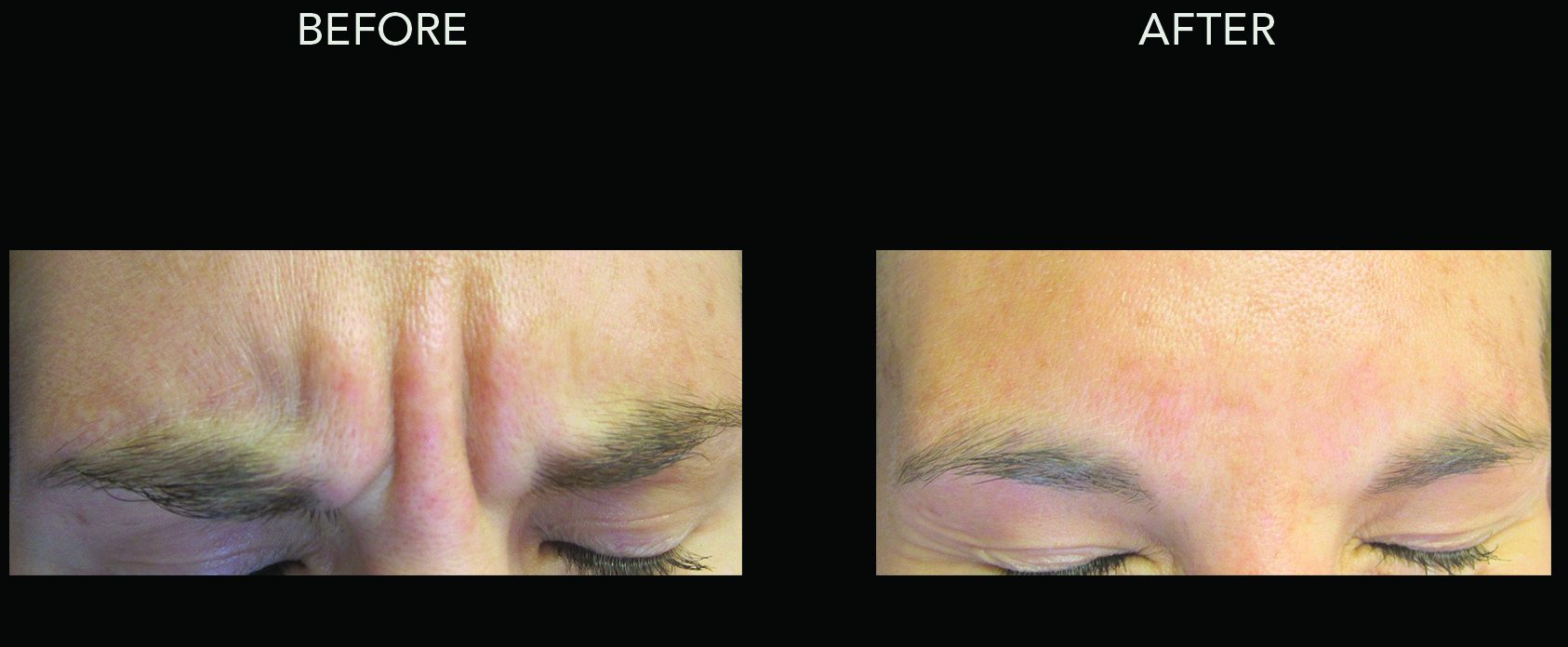 botox for glabella before and after