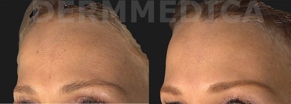 botox forehead wrinkle smoothing