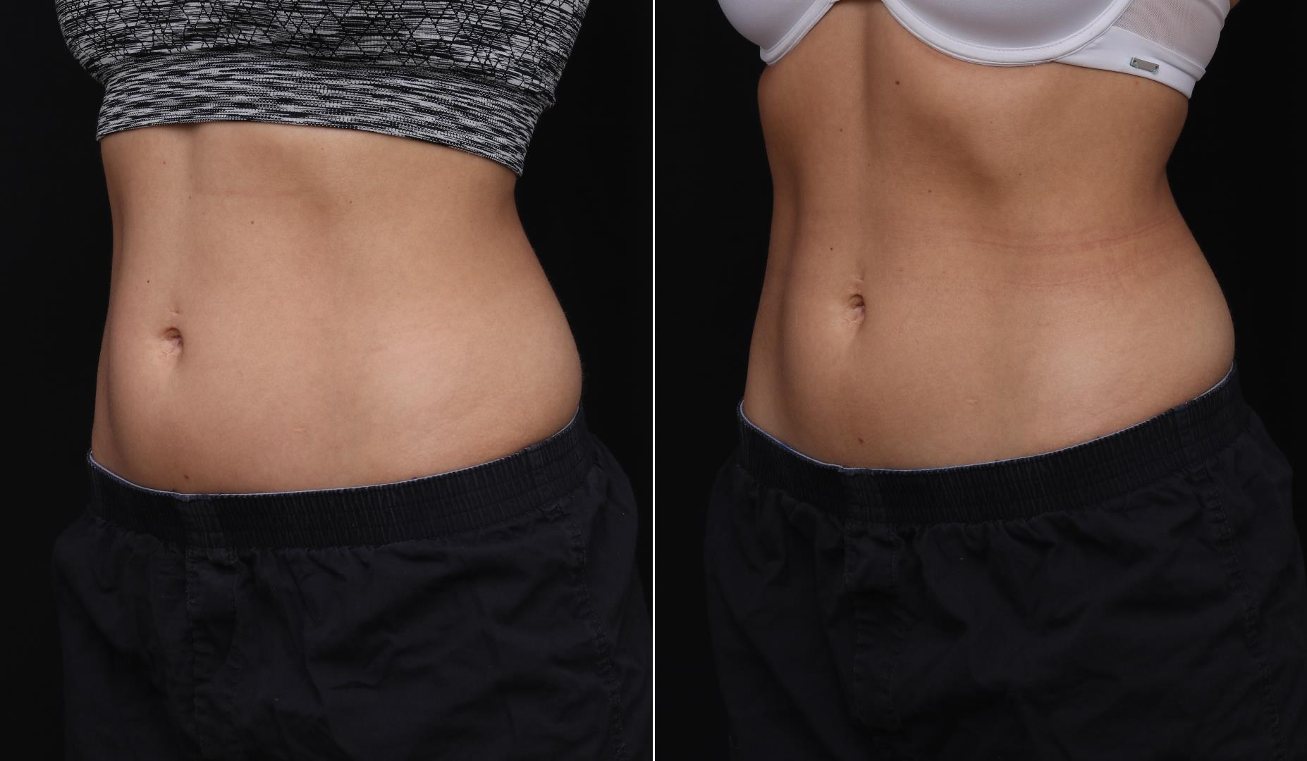 coolsculpting before after abdomen patient 13