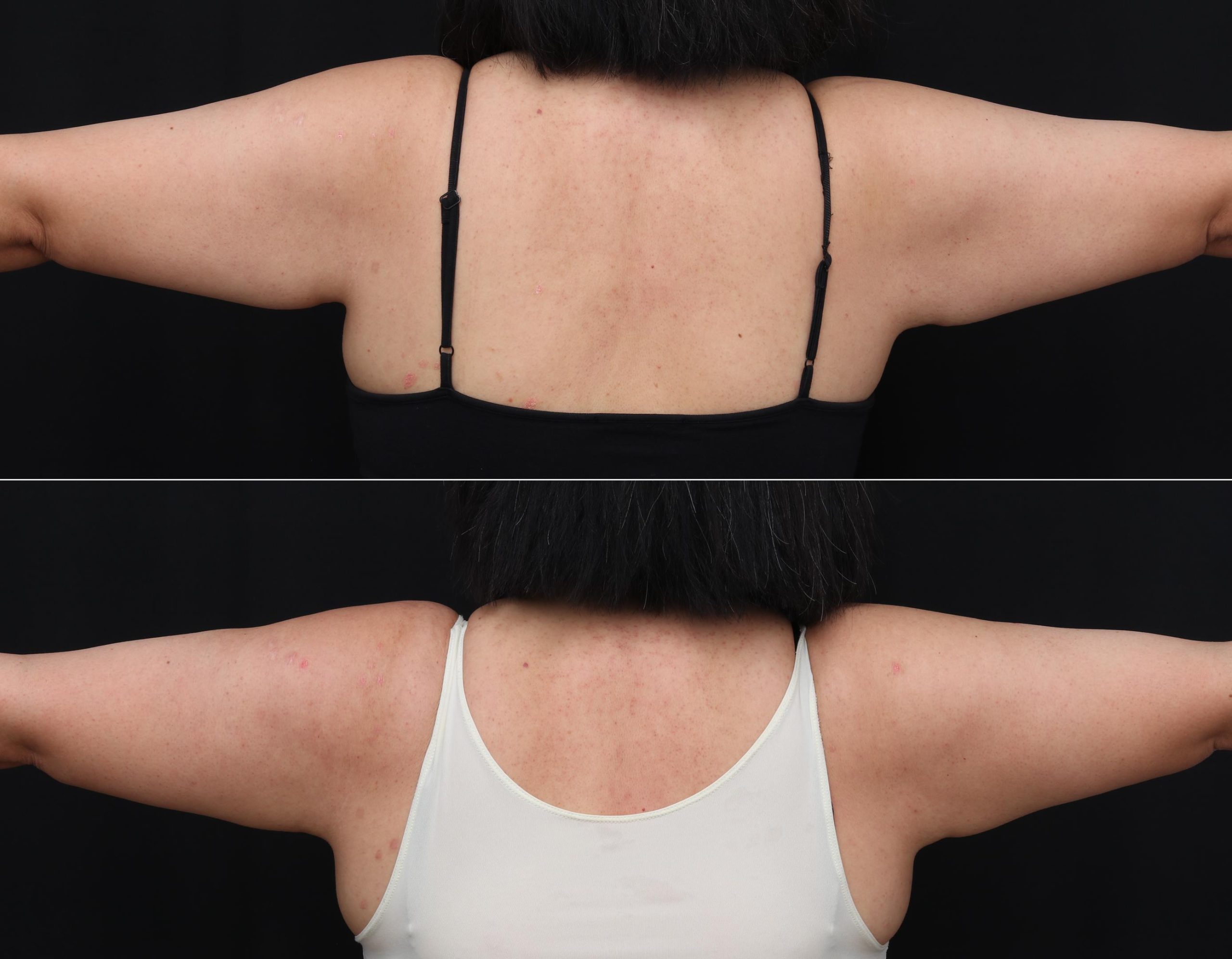 coolsculpting before after abdomen patient 14