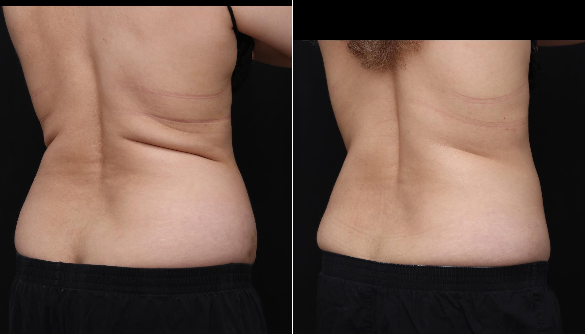 coolsculpting before after abdomen patient 15 - R