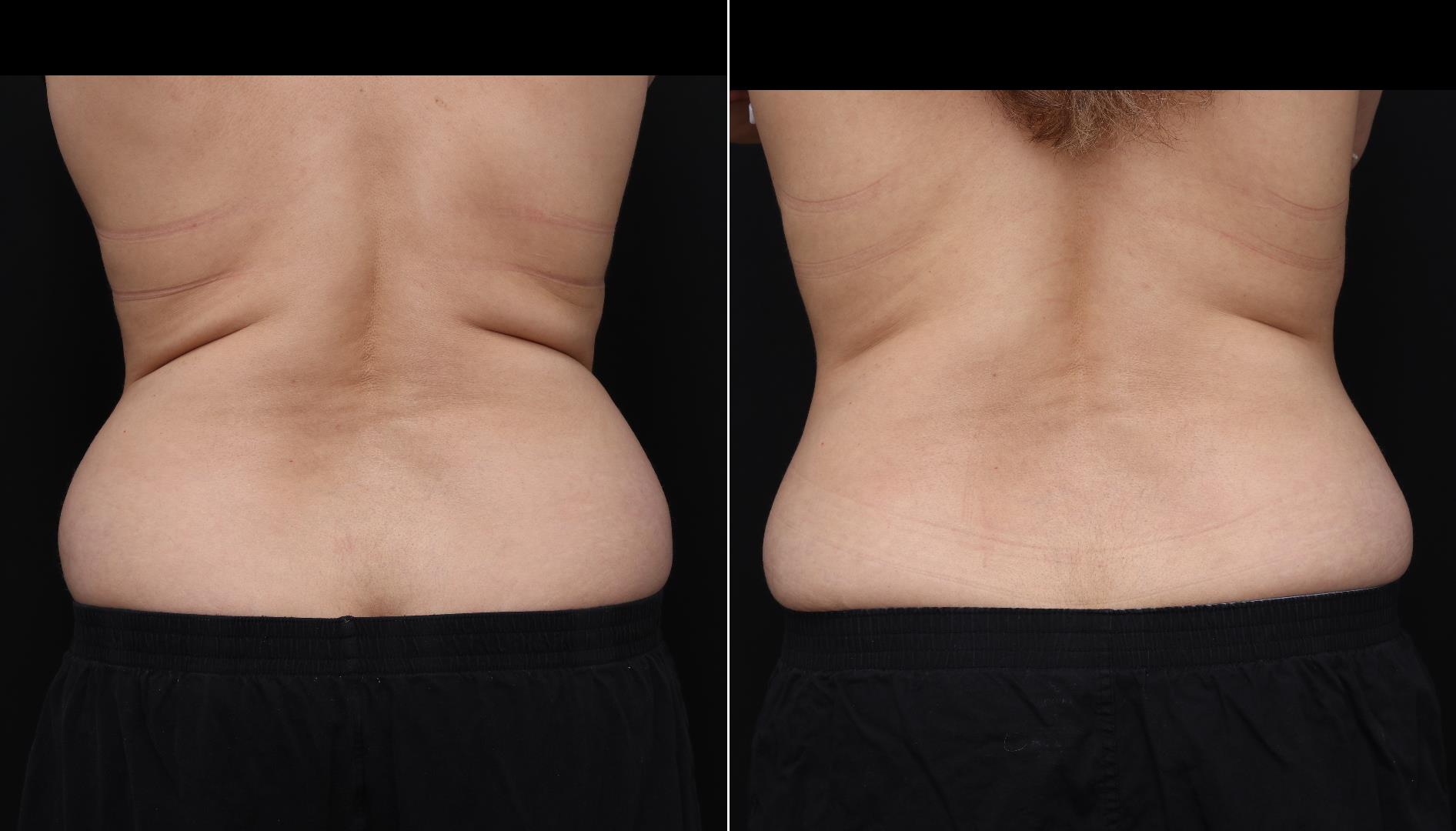 coolsculpting before after abdomen patient 15