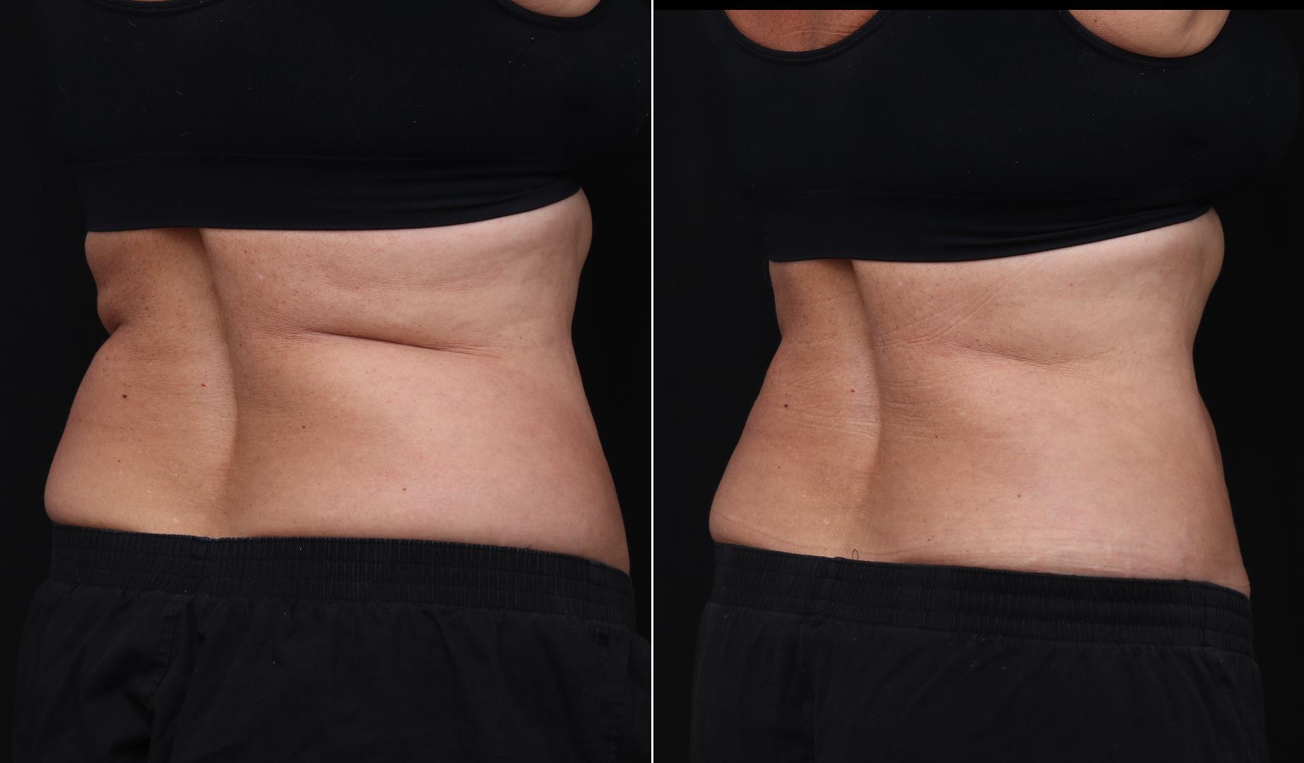 coolsculpting before after abdomen patient 16 - R