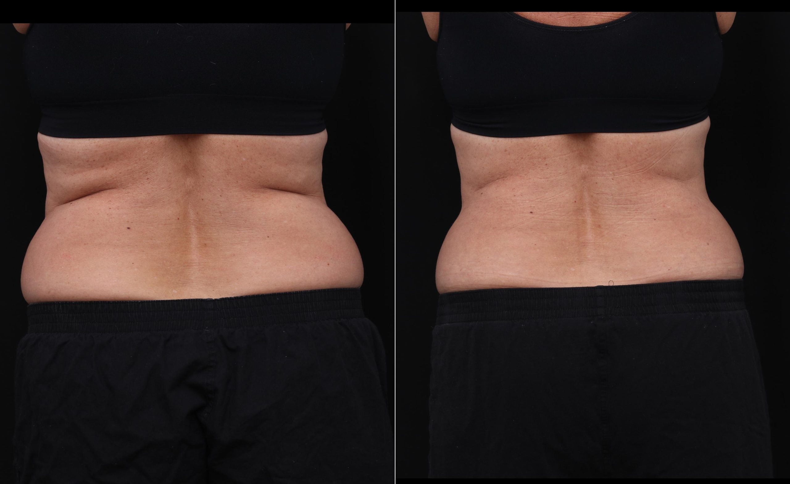 coolsculpting before after abdomen patient 16