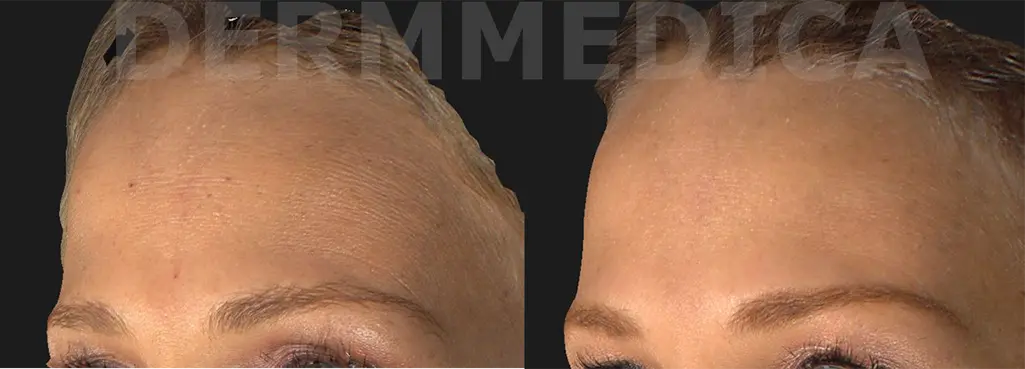 botox kelowna forehead