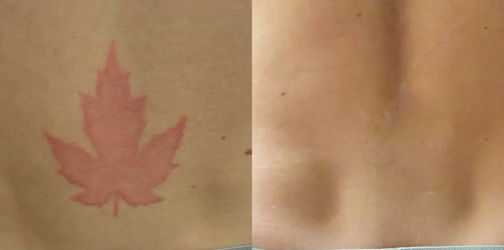 laser tattoo removal kelowna 2